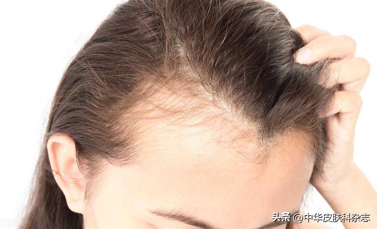 每次洗头的时候都有几十根头发脱落，这正常吗？