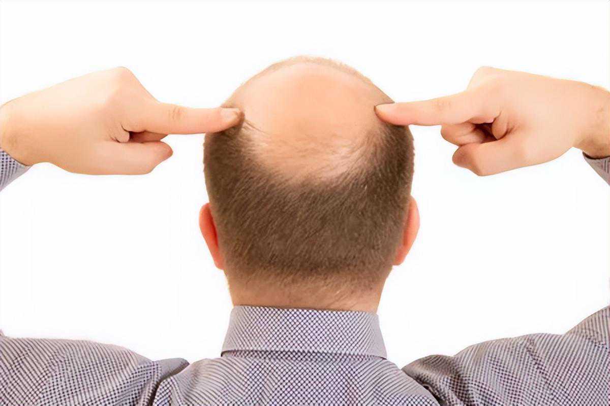 已经掉了的头发还能长回来吗？别急！医生告诉你怎么生发