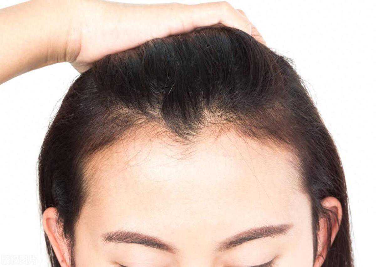 经常扎头发发际线会变高吗？如何拯救越来越高的发际线？5个方法